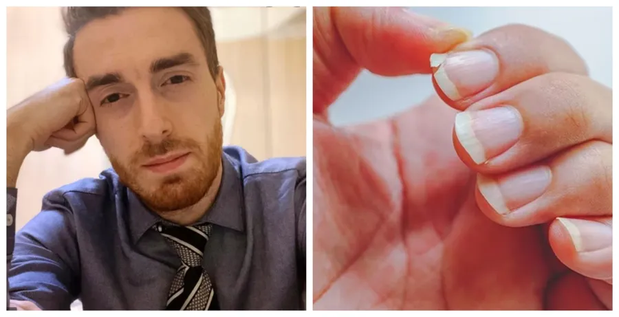 თუ ფრჩხილები ადვილად გტყდებათ, თმა გცვივათ, კანის სიმშრალე გაწუხებთ – გიორგი ღოღობერიძე 3 ყველაზე გავრცელებულ მიზეზს ასახელებს, რომელთა გამოც შესაძლოა, მსგავსი პრობლემები გქონდეთ