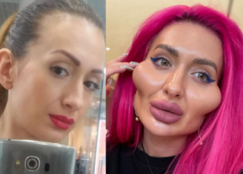 “ასე დაიმახინჯა ანამ თავი პლასტიკური ოპერაციებით” – ვინ არის გოგონა, რომლის ფოტოებმაც ინტერნეტსივრცე მოიცვა