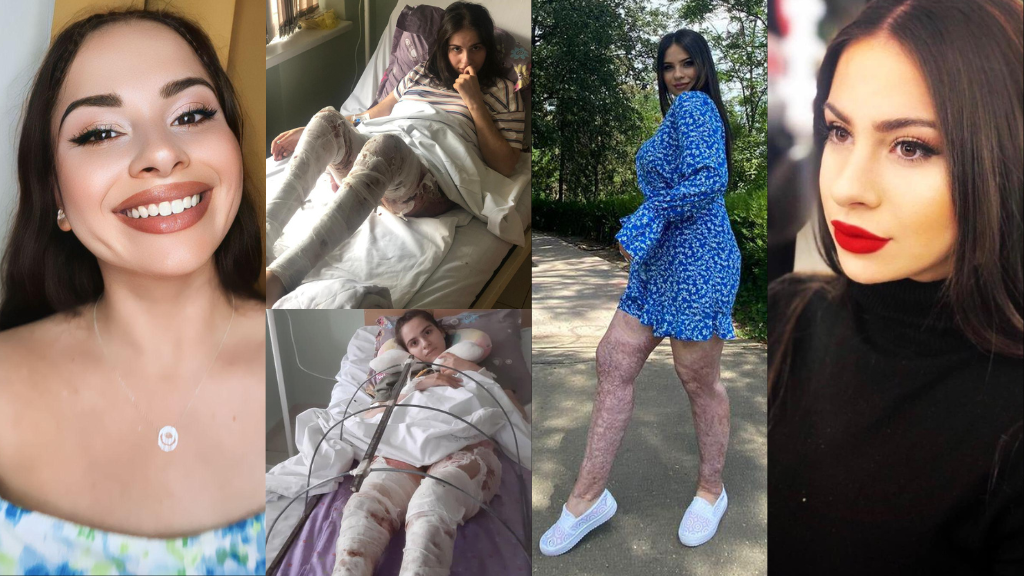 „მას შემდეგ, რაც ცოცხლად დავიწვი, ღმერთის გარდა აღარავის მეშინია, დამნაშავეს პატიმრობის 5 წელი მოაკლეს“ – როგორ ცხოვრობს გოგო, რომელსაც 5 წლის წინ შეყვარებულმა ბენზინი გადაასხა და ცეცხლი წაუკიდა