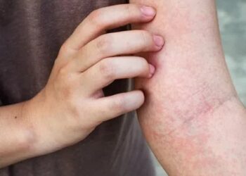 8 ნიშანი იმისა, რომ სისხლძარღვებში საშიში თრომბი გაქვთ