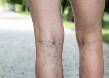 მთავარი ნიშნები, რითაც მიხვდებით, რომ სისხლძარღვებში საშიში თრომბი გაქვთ