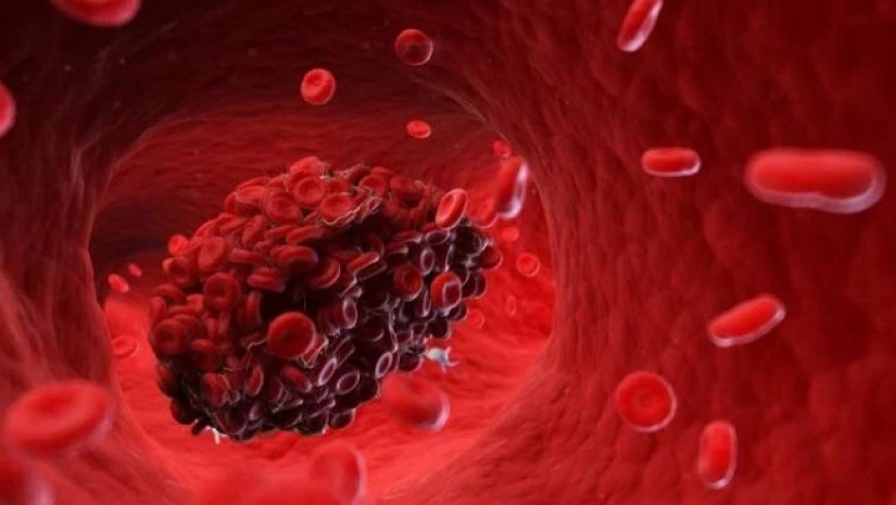 8 მთავარი ნაშანი იმისა, რომ სისხლძარღვებში საშიში თრომბი გაქვთ