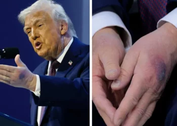 რა დაემართა ტრამპს ხელებზე და რატომ აქვს სისხლჩაქცევები – “ექიმმა მითხრა, რომ…”