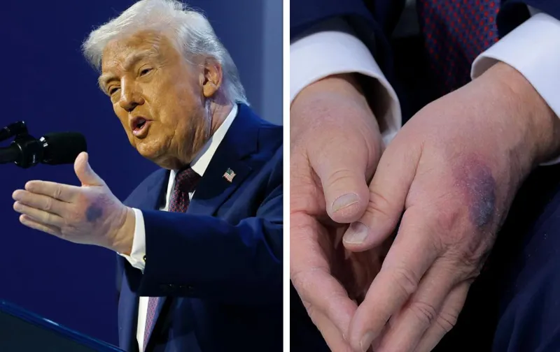 რა დაემართა ტრამპს ხელებზე და რატომ აქვს სისხლჩაქცევები – “ექიმმა მითხრა, რომ…”